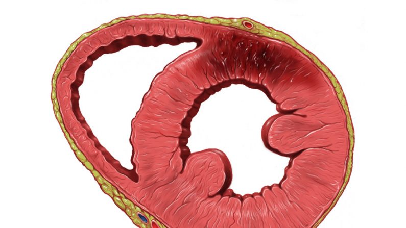 Representação do músculo de um coração enfartado (Internet)