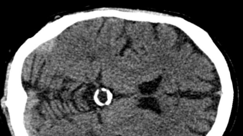 Cisto de glândula pineal calcificada visualizada em CT ( Hellerhoff)