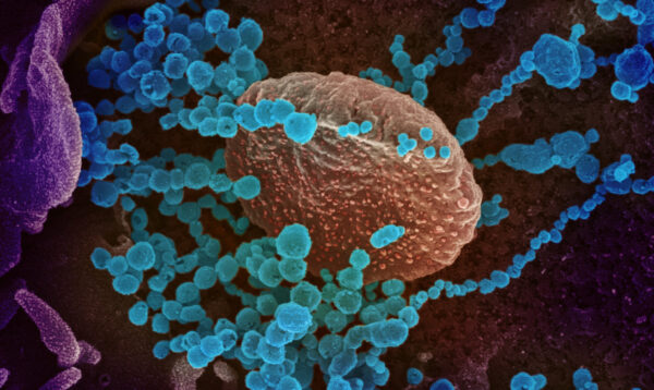 A imagem do microscópio eletrônico de varredura mostra o vírus do PCC (objetos redondos azuis), o vírus que causa o COVID-19, emergindo da superfície de células cultivadas em laboratório (NIAID-RML)
