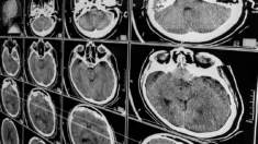 Pessoas próximas da morte por lesão cerebral traumática ainda podem reviver, diz estudo
