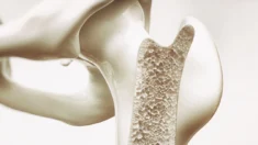 Nova descoberta hormonal revela esperança para o tratamento da osteoporose