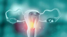 Maioria das mulheres com miomas uterinos recomendam remoção cirúrgica do útero