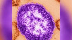 CDC afirma que casos de sarampo nos EUA já triplicam o total de 2023