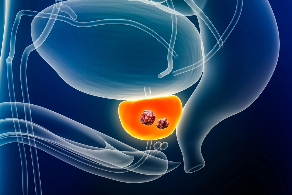 Câncer de próstata: 5 principais sintomas do e abordagens de tratamento