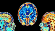 FDA aprova tratamento de tumor cerebral pela farmacêutica Servier