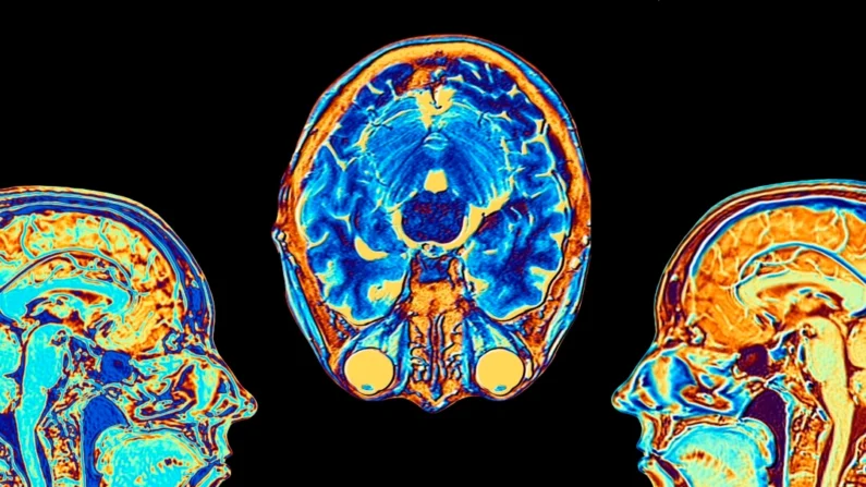 Uma foto de arquivo sem data mostra imagens de ressonância magnética (MRI) em cores falsas aprimoradas por computador de estruturas cerebrais. (Alfred Pasieka/Science Photo Library/Getty Images)
