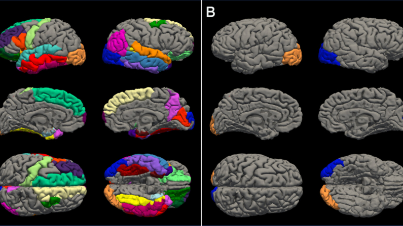 Regiões com afinamento cortical significativamente acelerado no cérebro de adolescentes pós-COVID-19. As regiões com afinamento acelerado no cérebro feminino (A) e no cérebro masculino (B) são mostradas em cores (Imagem: Corrigan, Rokem e Kuhl 2024  https://orcid.org/0000-0002-4080-5212)