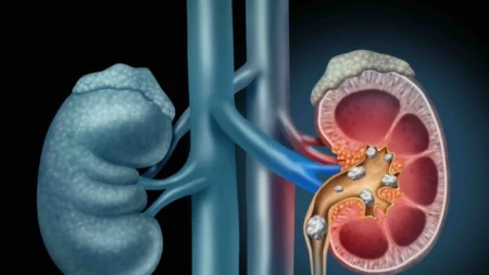 Uma bactéria específica em sua urina pode ajudar a proteger contra pedras nos rins