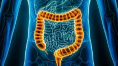 Dieta com baixo teor de amido e açúcar é promissora no alívio da síndrome do intestino irritável