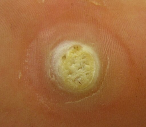 Verruga plantar (Foto: James Heilman, MD)