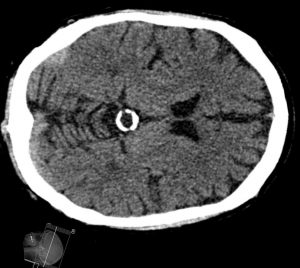 Cisto de glândula pineal calcificada visualizada em CT. Fonte: Hellerhoff