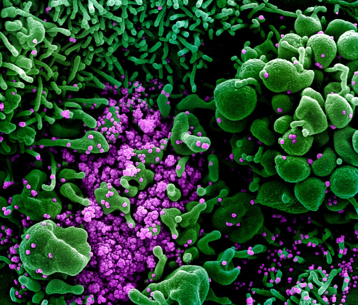 Micrografia eletrônica de varredura em cores de uma célula (verde) fortemente infectada com partículas do vírus do PCC (roxo), comumente conhecidas como vírus SARS-CoV-2 ou CCP, isoladas de uma amostra de paciente, publicada em 16 de março de 2020 (NIAID)